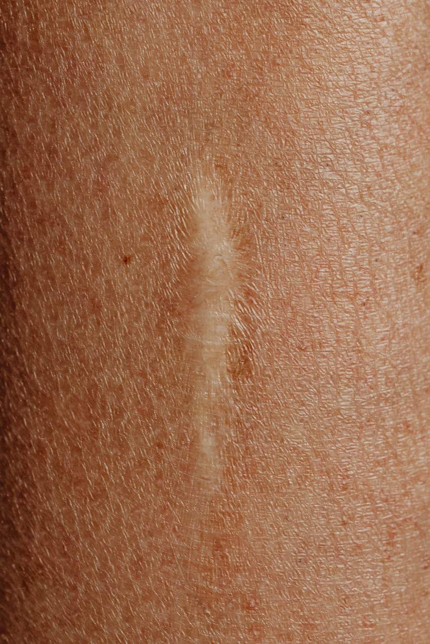 Scar Tissue – The Best Interest